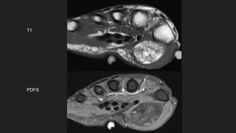 Figure 1 for case chondroma ( RID4126 )